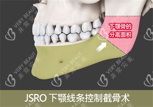 雙鄂手術(shù)下顎示意圖
