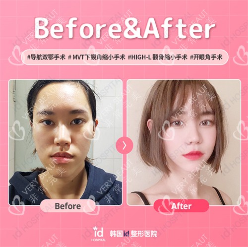 韓國ID醫(yī)院雙鄂手術對比照
