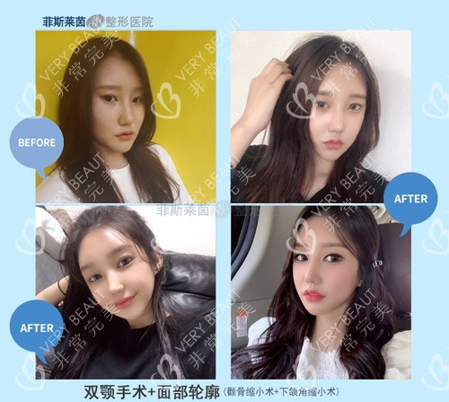 韓國菲斯萊茵雙鄂手術前后圖