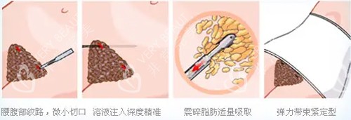 吸脂手術(shù)動(dòng)畫圖