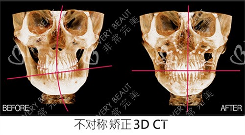   韓國faceline面部不對稱調(diào)整