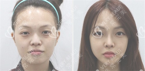 在韩国伊美芝整形外科做轮廓手术实例图