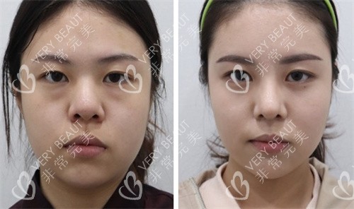韩国伊美芝整形外科轮廓手术前后对比图