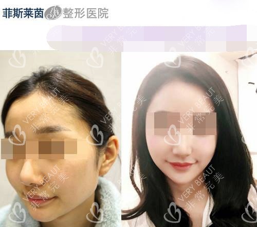 韓國菲斯萊茵整形醫(yī)院輪廓整形示意圖
