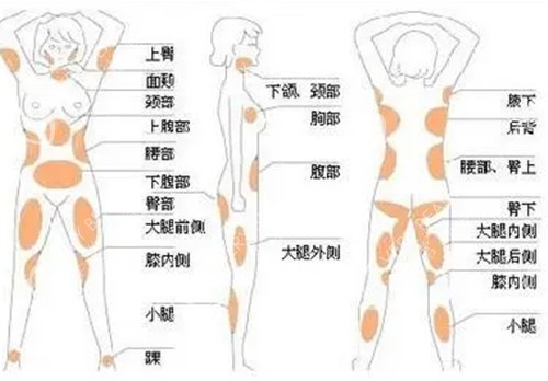 身体不同吸脂位置示意图