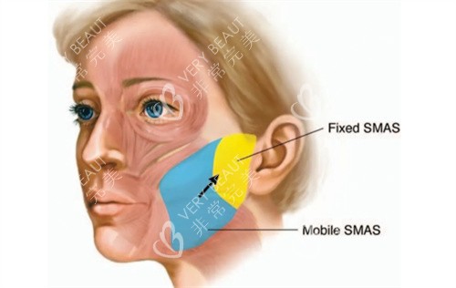 面部拉皮手术操作方式动画演示图