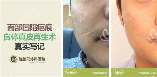 韩国陈整形外科面部凹陷疤痕治疗前后对比