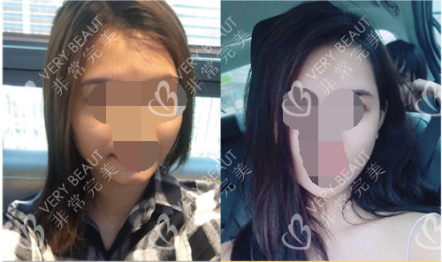 韓國珠兒麗整形立體豐潤額頭