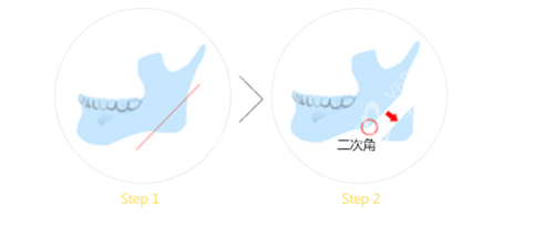 V-line方下頜整形下頜角手術(shù)