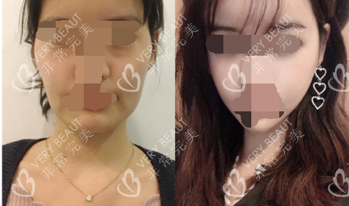 韓國珠兒麗整形醫(yī)院輪廓整形