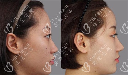 韩国伊美芝整形医院鼻修复手术展示图