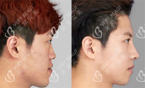 韩国伊美芝整形医院男性隆鼻展示图