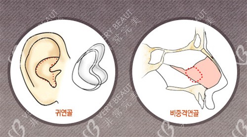 韩国赫拉整形耳软骨隆鼻展示图
