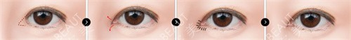 韩国大眼睛整形外科双眼皮术式展示图