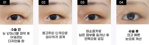 韩国大眼睛整形外科开眼角方法展示图