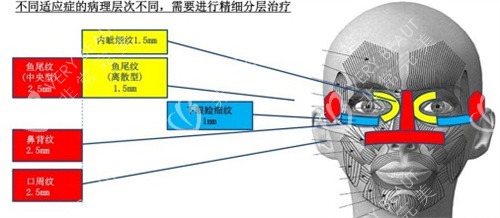热拉提针对的面部不同适应症展示图