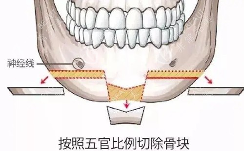 下颏成型术截骨区域示意图