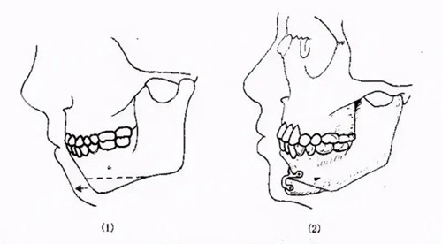 下颏成型术解决下巴后缩问题示意图