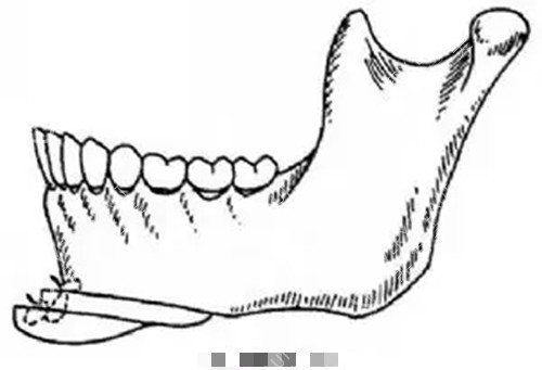 下颏截骨成型术示意图