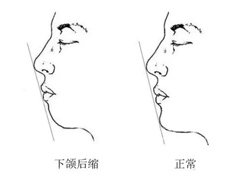 下巴后缩以及正常卡通对比示意图