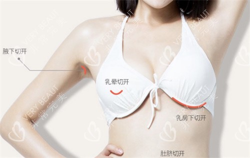 韓國(guó)MD整形外科四種不同方法隆胸圖