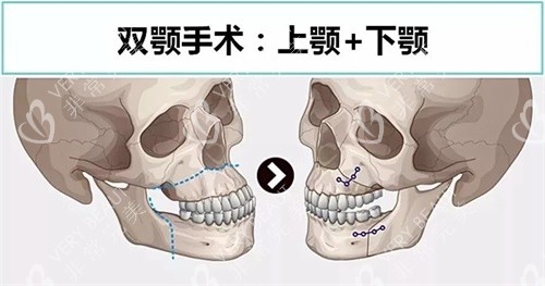 上鄂手術(shù)和下顎手術(shù)示意圖