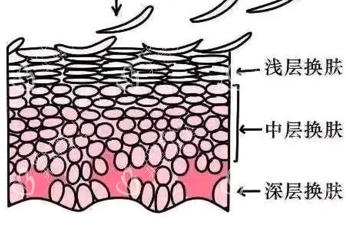 果酸换肤不同层面示意图