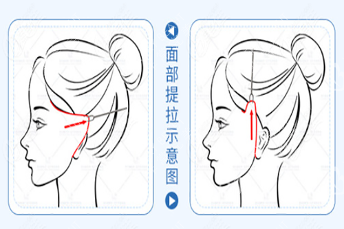 面部不同方向拉皮对比示意图