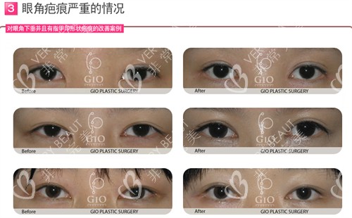 韓國GIO整形外科眼角疤痕修復對比