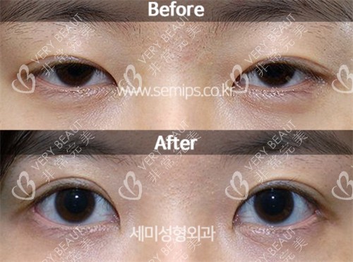 韩国世美整形外科眼修复对比