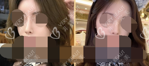 韓國溫度整形醫(yī)院隆鼻實(shí)例對(duì)比