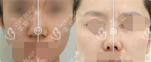 韓國溫度整形醫(yī)院隆鼻前后示意圖