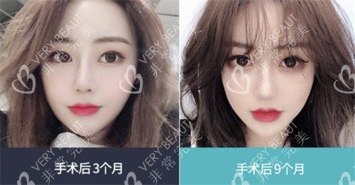 韓國TS整形輪廓手術(shù)真人恢復(fù)圖