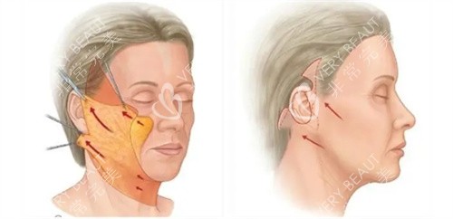 面部拉皮手术操作方法展示图
