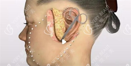 面部拉皮手术耳前切口展示图