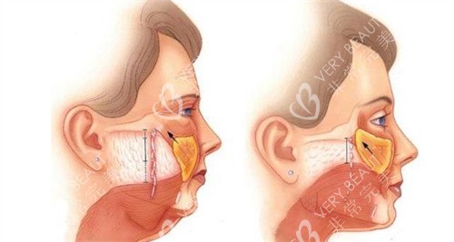 面部拉皮手术肌肉组织变化图