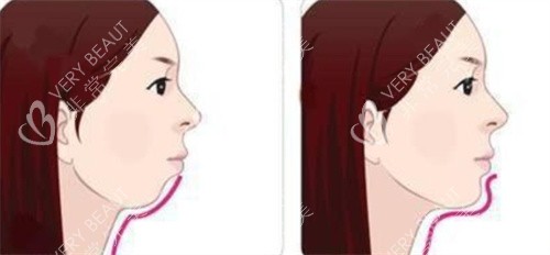 下巴后縮矯正前后對(duì)比圖