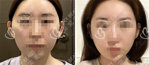 韓國TS整形顴骨縮小真人實例圖