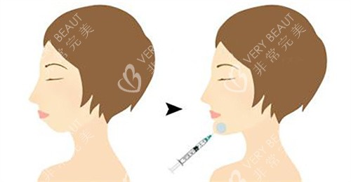 玻尿酸注射下巴動(dòng)畫圖