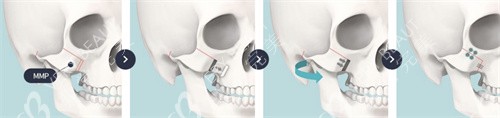 韓國TS整形tsl截骨方法圖