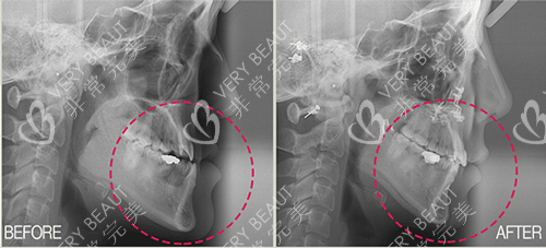 韩国菲斯莱茵整形外科双颚手术改善照片