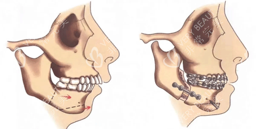 正颌正畸联合手术图片