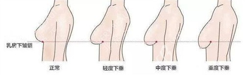 不同程度胸部下垂说明图