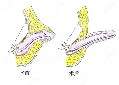 吸脂改善阴茎长短示意图