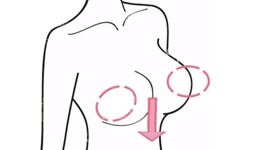 胸部下垂过程展示图