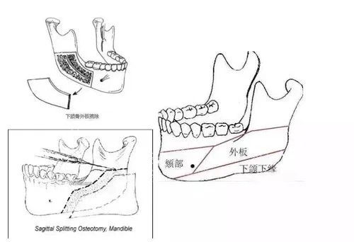 下颌骨结构示意图