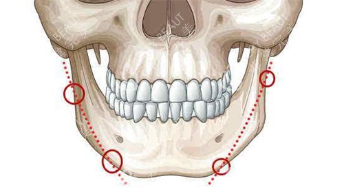 下颌角手术不留角方法图