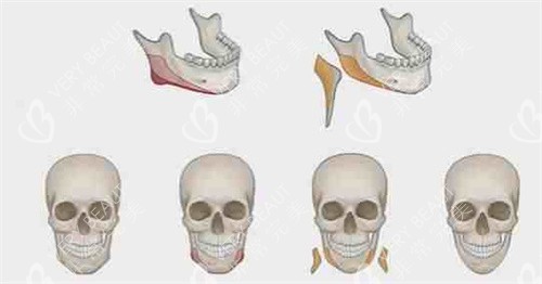 下颌角截骨手术流程图