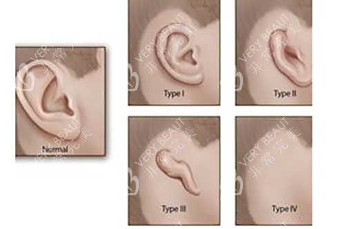 不同需要矫正的耳朵形态示意图