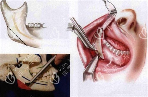 截骨手术切口展示图